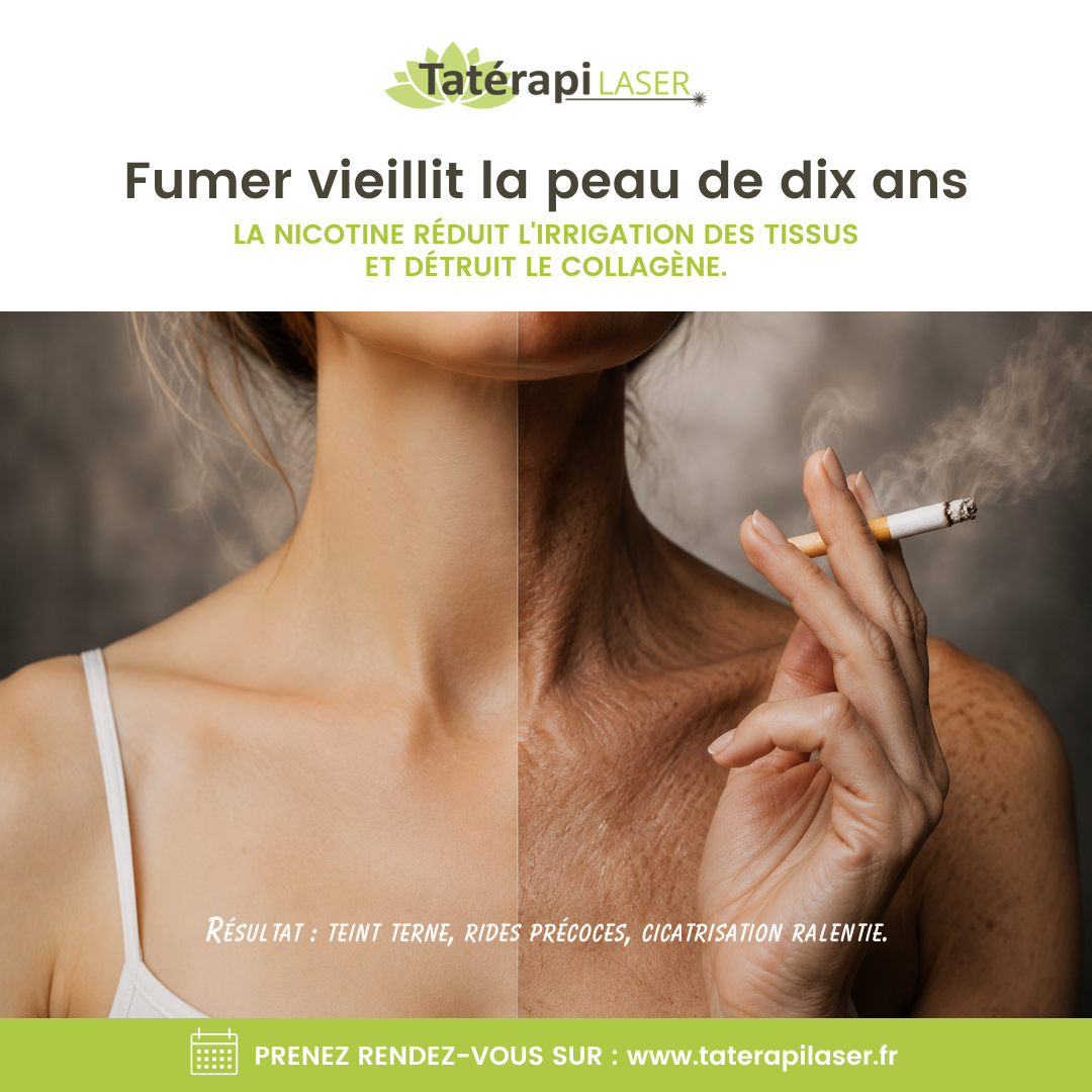 Tatérapi Laser Chaumont